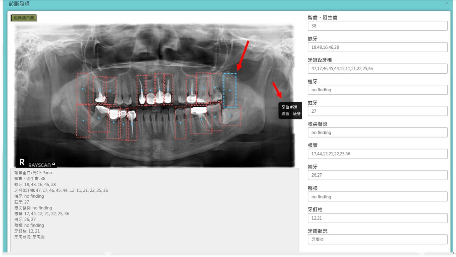 AI 判讀 X 光片畫面